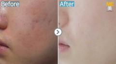 Singapore / Acne scar (Legato & PRP)