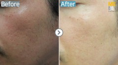 Singapore / Acne scar (Fraxel & PRP)