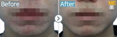 Singapore / Acne scar (Fraxel & PRP)