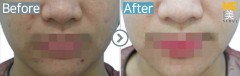 Singapore / Acne scar (Fraxel & PRP)