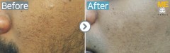 Singapore / Acne scar (Fraxel & PRP)