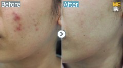 Singapore / Acne scar (Fraxel & PRP)