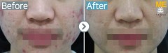 Singapore / Acne scar (Fraxel xena)