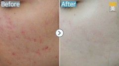 Singapore / Acne scar (Fraxel xena)