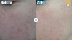 Singapore / Acne scar (Fraxel xena)