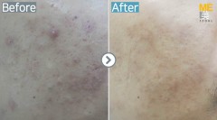 Singapore / Acne scar (Fraxel xena)