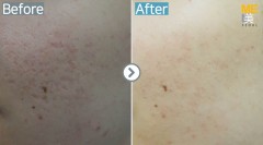 Singapore / Acne scar (MTS & PRP)