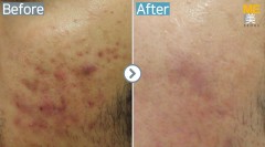 Singapore / Acne scar (MTS & PRP)
