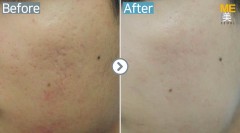 Singapore / Acne scar (MTS & PRP)