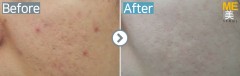 Singapore / Acne scar (MTS & PRP)