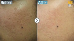 Singapore / Acne scar (Legato)