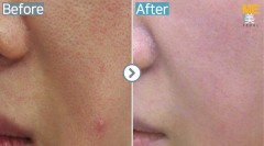 Singapore / Acne scar (Legato)