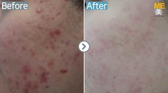 Singapore / Acne scar (Legato)