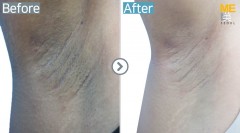UK / Laser toning