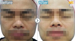 Vietnam / Laser toning