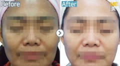 Singapore / Dual toning