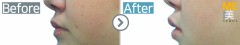USA / Anti-Wrinkle (lip)