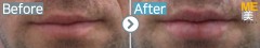 Germany / Anti-Wrinkle (lip)