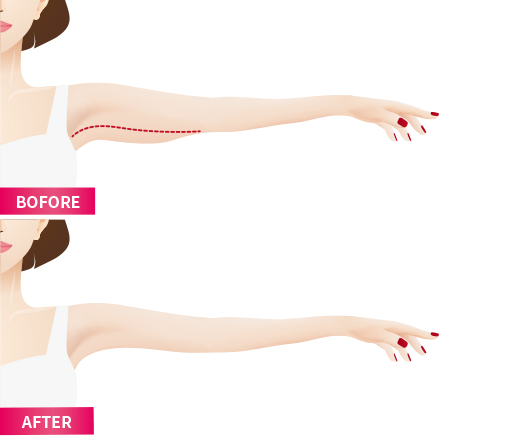 Arm&thigh lifting