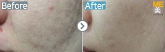 Singapore / Acne scar (Legato & PRP)