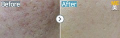 Singapore / Acne scar (Legato)