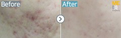 Singapore / Acne scar (Legato)