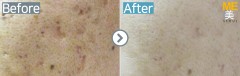 Singapore / Acne scar (Legato)