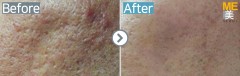 Singapore / Acne scar (Legato)