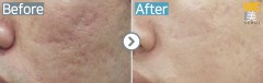 Singapore / Acne scar (Legato)