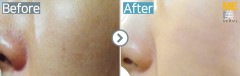 Singapore / Rejuran healer