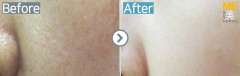 Singapore / Rejuran healer