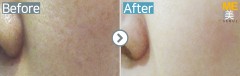 Singapore / Rejuran healer