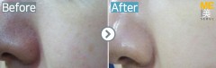 Singapore / Rejuran healer