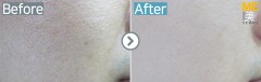 Singapore / Acne scar (Fraxel xena)