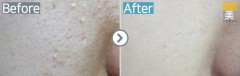 Singapore / Acne scar (Fraxel xena)