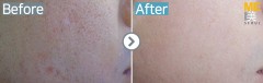 Singapore / Acne scar (Fraxel xena)