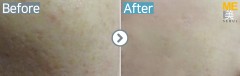 Singapore / Acne scar (Fraxel xena)