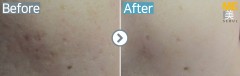 Singapore / Acne scar (Fraxel xena)