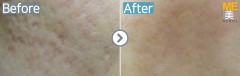 Singapore / Acne scar (Fraxel xena)