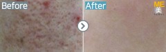 Singapore / Acne scar (Fraxel xena)