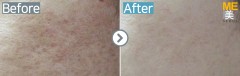Singapore / Acne scar (Fraxel xena)