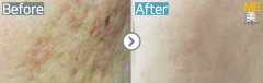 Singapore / Acne scar (Fraxel xena)