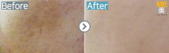Singapore / Acne scar (Fraxel xena)