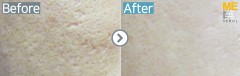 Singapore / Acne scar (Fraxel xena)