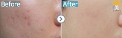 Singapore / Acne scar (Fraxel xena)