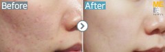 Singapore / Acne scar (Fraxel xena)