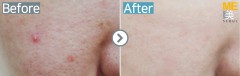 Singapore / Acne scar (Fraxel xena)