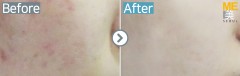 Singapore / Acne scar (Fraxel xena)