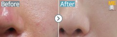 Singapore / Acne scar (Fraxel xena)