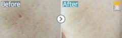 Singapore / Acne scar (Fraxel xena)